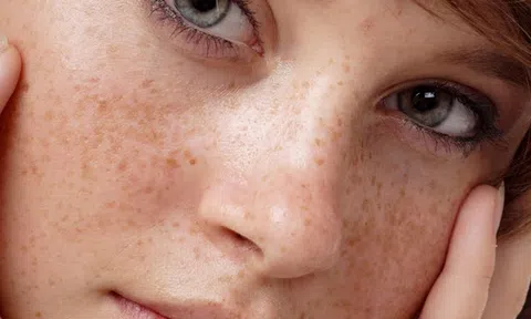 Mách bạn cách trị tàn nhang siêu dễ ngay tại nhà