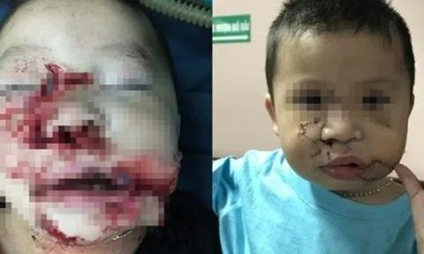 Phẫu thuật tạo hình cho bé trai 2 tuổi bị chó cắn nát mặt