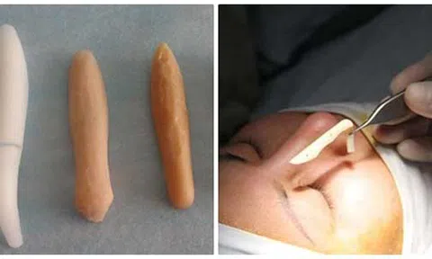 Ưu điểm của sụn nhân tạo trong nâng mũi hiện đại