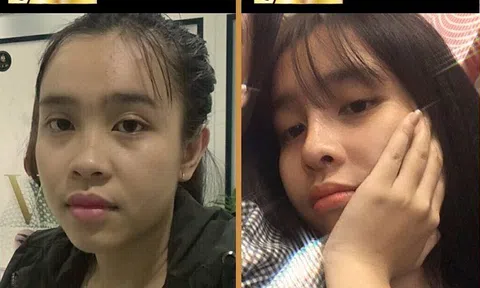 Nâng mũi Sline “xưa mà không cũ”