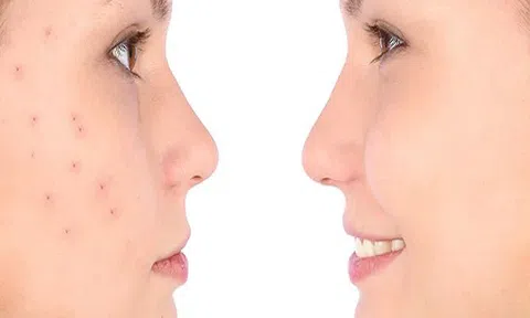 Để nhanh lành sẹo mụn các chị em nhớ áp dụng những mẹo dưới đây