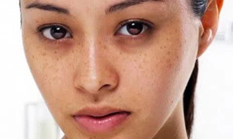 Double White vũ khí \'giải nám, tàn nhang\' cho làn da