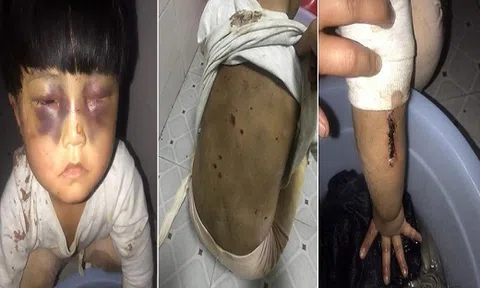 Trung Quốc: Bé gái bị bố đánh bầm tím mặt, xích trong nhà vệ sinh