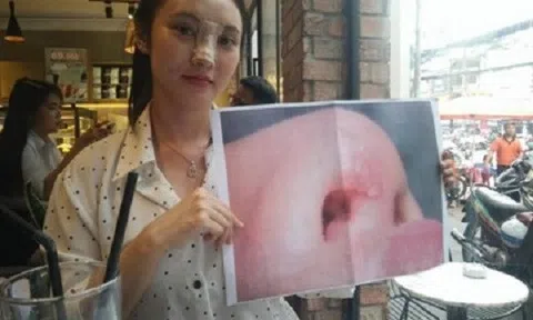 Người đẹp `tố` thẩm mĩ viện làm hỏng mũi sau khi phẫu thuật