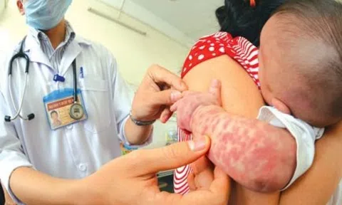 Cảnh báo nguy cơ dịch sởi quay trở lại trong năm nay