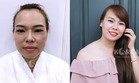 Tại sao phải sống chung với nám nếu bạn biết cách chữa trị?