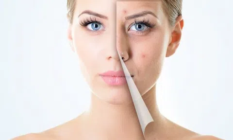 Suy nghĩ tích cực về làn da bị mụn – Xóa bỏ tự ti về ngoại hình