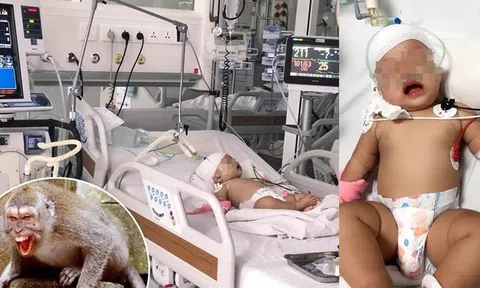 Khỉ xổng chuồng cắn rách đầu bé gái hơn 1 tuổi