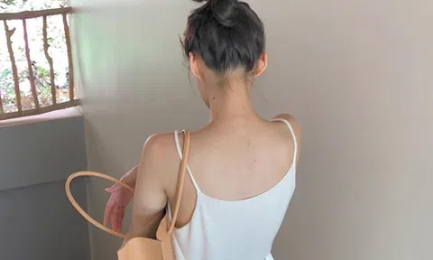 3 tips giúp bạn đánh bay mụn lưng để thỏa sức diện bikini hè này