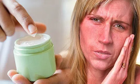 Các chị em hãy học ngay những bí quyết  này để phục hồi làn da cháy nắng