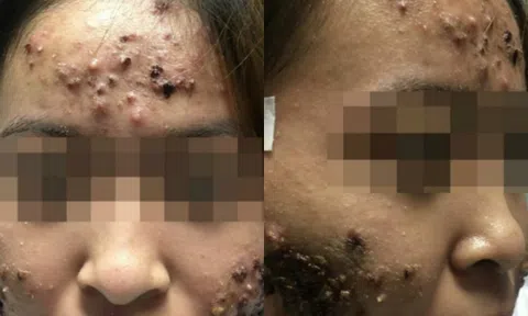 Chủ quan chữa ở phòng khám tư, cô gái bị lên đầy mụn trứng cá, mụn mủ trên mặt