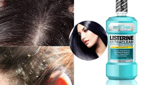 Bật mí mẹo trị gàu đơn giản mà hiệu quả với nước súc miệng listerine
