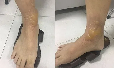 Hà Nội: Quý ông vô tình bị bỏng nặng khi đi mát xa chân