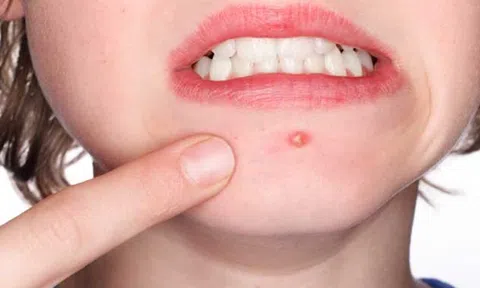 Cách trị mụn bọc trả lại làn da căng bóng, ai mà không biết là phí cả đời!