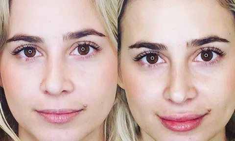 Lo sau khi rút filler đôi môi có trở lại tự nhiên thì đây là câu trả lời cho bạn