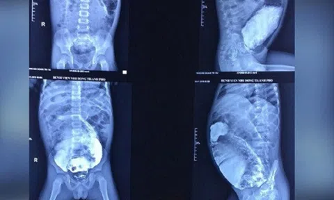 Bụng bé trai phình to như phụ nữ mang thai sau 5 năm táo bón