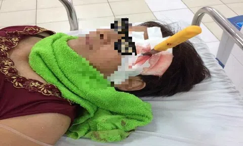 Trượt chân, người phụ nữ bị dao gọt hoa quả đâm xuyên vào trong sọ não