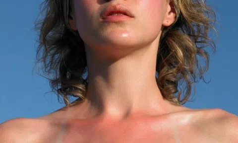 Ngộ độc ánh sáng – Kẻ thù thầm lặng của làn da mùa nóng