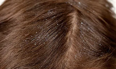 Trị gàu trong mùa hè hiệu quả với muối