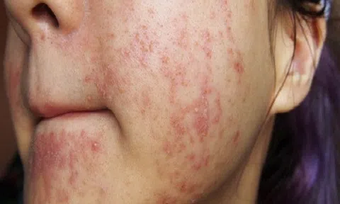 5 bước “giải cứu” làn da khi bị dị ứng mỹ phẩm