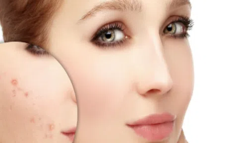 Đánh bay vết thâm do mụn bằng những nguyên liệu tự nhiên rẻ tiền có trong nhà bếp