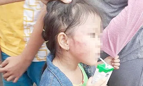 Bất ngờ với lời khai của bảo mẫu tát bầm tím mặt bé gái 5 tuổi ở TP.HCM