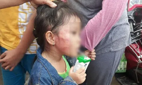 Vụ bé gái bị bảo mẫu tát rạn xương hàm: Phát hiện trong tai bé có máu bầm