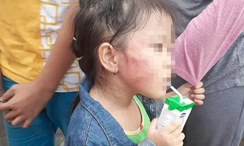 Từ vụ cô giáo đánh trẻ em nứt xương hàm: Cần có chế tài xử phạt nặng hơn