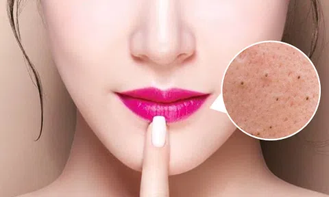 5 mẹo đánh bay mụn đầu đen xung quanh môi nhanh và hiệu quả