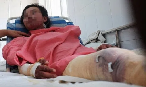 Bình gas mini phát nổ lúc nấu ăn, thiếu nữ 18 tuổi bị bỏng nặng