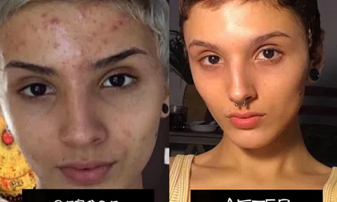 Quá trình tái sinh làn da thần kỳ của cô gái sau khi chăm chỉ dùng retinol