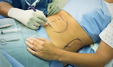 Số phận bi thảm của cô gái hút mỡ đầu tiên trên thế giới