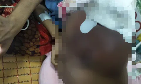 Bé trai 6 tháng tuổi mang khối u khổng lồ do đắp thuốc lá trôi nổi