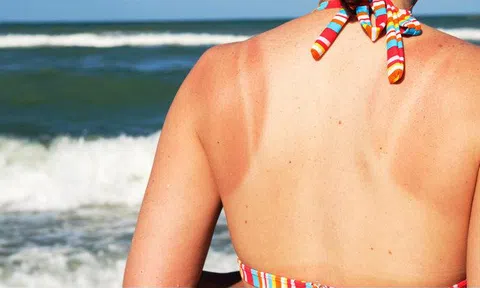 Phương pháp khôi phục làn da cháy nắng bạn nên biết