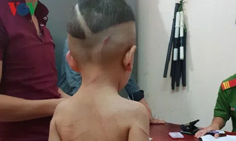 Khởi tố, bắt tạm giam cha dượng bạo hành con riêng của vợ ở Phú Quốc