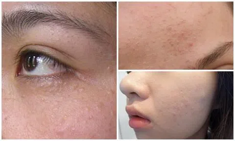 Cách loại bỏ mụn ẩn dưới da, đem lại làn da trắng hồng đơn giản, ít tốn kém