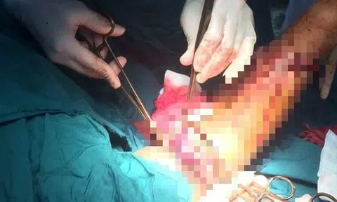 Câu cá ngừ, một ngư dân tại Bình Định bị cá cắn đứt lìa bàn tay giữa biển