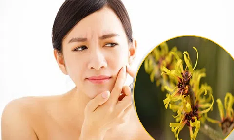 Có thể bạn chưa biết, nước cây Phỉ có tác dụng \'đánh bay\' mụn đầu trắng nhanh nhất