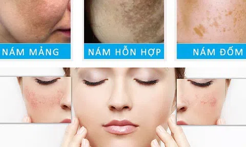 Trong uống ngoài thoa – Triệt tiêu gốc nám