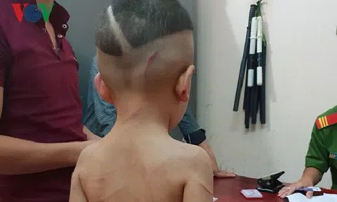 Vụ cha dượng bạo hành con riêng của vợ ở Phú Quốc: Bé trai bị thương tật 24%