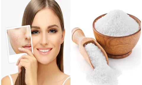 Muối biển - `câu thần chú` giúp loại bỏ mụn trứng cá một cách hiệu quả
