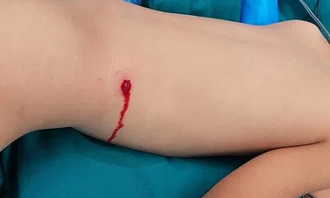 Bé trai 5 tuổi bị đạn bi xuyên thủng thắt lưng, găm vào cột sống vì nghịch súng hơi