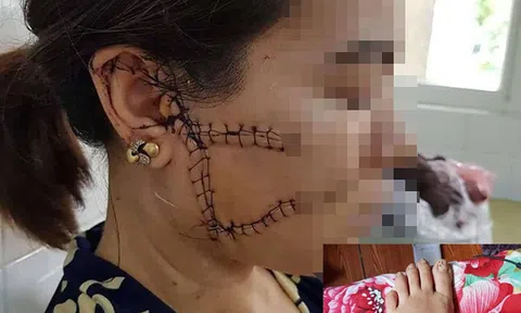 Người vợ tiết lộ lý do bị chồng hờ rạch mặt, cắt gân chân