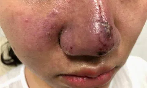 Nguy hiểm: Lại thêm 1 trường hợp méo mặt, mũi bọc mủ vì tiêm filler làm đẹp