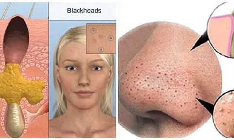 Những tuyệt chiêu giúp bạn trị mụn cám đáng ghét, trả lại làn da đẹp không tì vết