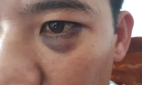 Học sinh dẫn người lạ vào trường hành hung thầy giáo gãy xương mũi