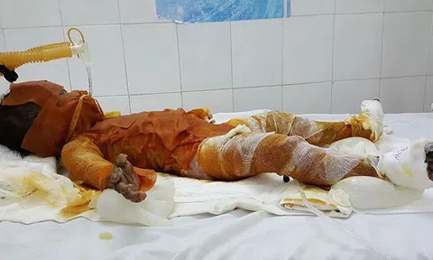 3 chị em nhỏ lấy lá chuối khô đốt lửa chơi gây cháy nhà, bé 2 tuổi bỏng 90%