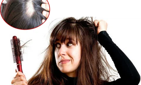 Không muốn hói đầu bạn nhất định phải bỏ ngay những thói quen này