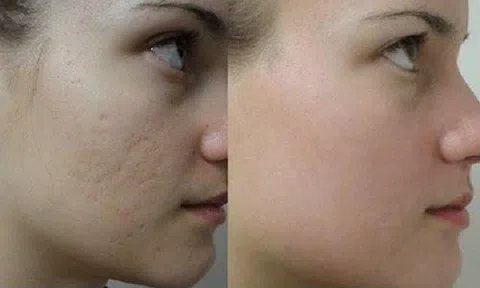 2 công thức loại bỏ sẹo thâm hiệu quả, nhanh chóng 