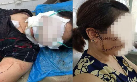 Khởi tố gã chồng dùng dao rạch mặt vợ 